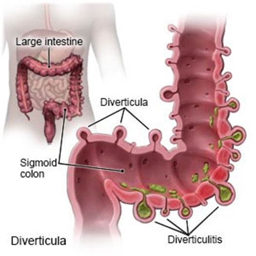 Diverticulosis/ Potholes on the GI Tract