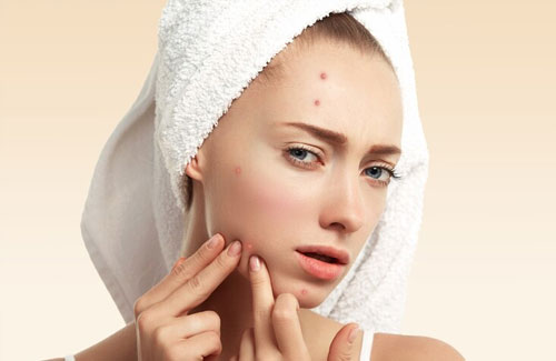 Acne & Pimples